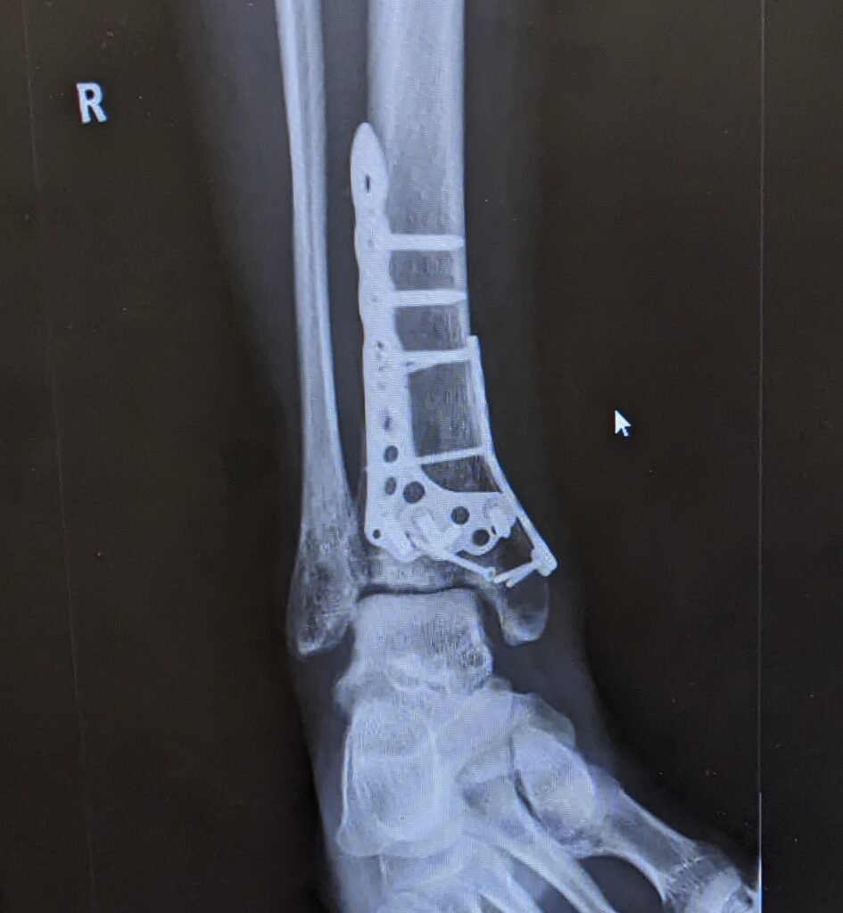an x-ray of my right leg showing extensive metal work after a climbing fall